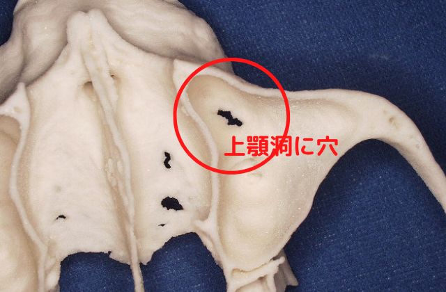 上顎洞炎｜高松市でインプラントなら吉本歯科医院